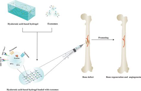 Smart Implantable Hydrogel for Large Segmental Bone .